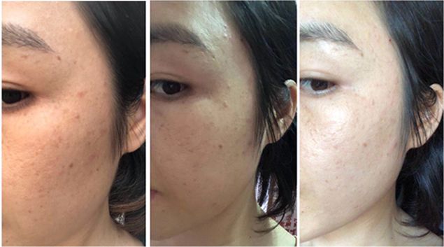 5个祛斑小妙招淡化晒斑雀斑痘印,痘印晒斑和疤痕用什么产品比较好