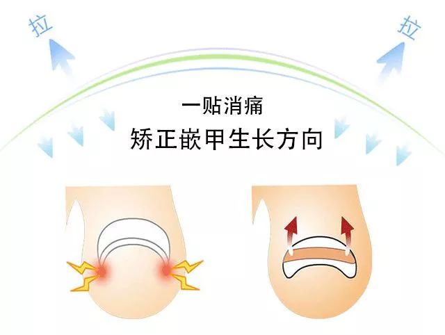 趾甲扎进肉里了，一碰就痛？用它一贴，1分钟止痛，趾甲往外长，再也不扎痛了！