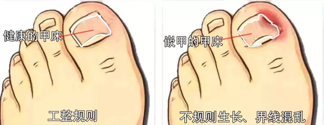 趾甲扎进肉里了，一碰就痛？用它一贴，1分钟止痛，趾甲往外长，再也不扎痛了！