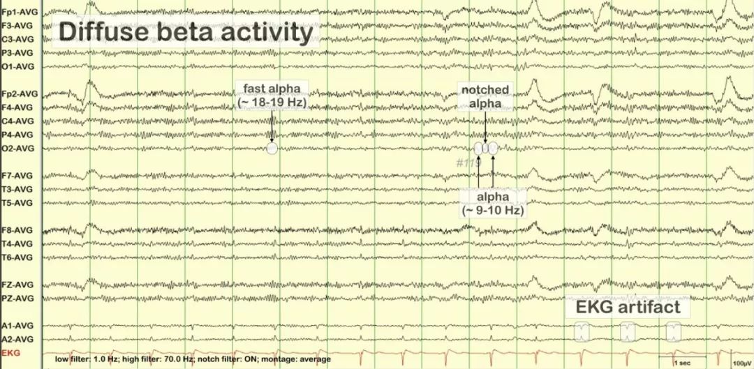 正常脑电图报告单图片,正常脑电图检查报告单第一页