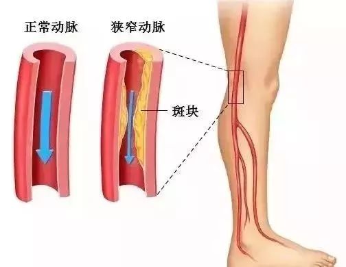 老年人补着钙还抽筋怎么处理,中老年人抽筋不能吃什么