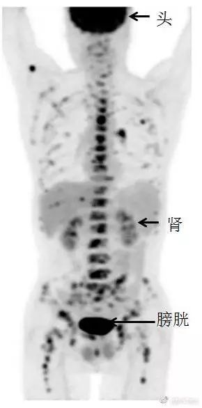 吸烟30年肺部ct图片,抽烟十年20年30年肺部的真实影像