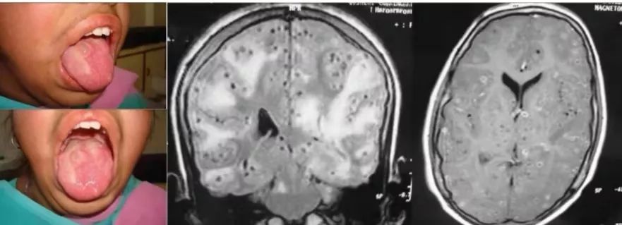 肥大性下橄榄核变性、Percheron动脉梗死、慢通道先天性肌无力综合征丨3分钟读片·31期