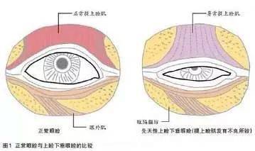 济南海峡整形医院整容案例,济南海峡整形医院割双眼皮怎么样