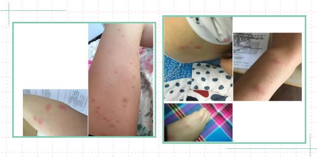 小孩子皮肤红肿瘙痒怎么回事,最近小孩皮肤过敏大面积红肿痒