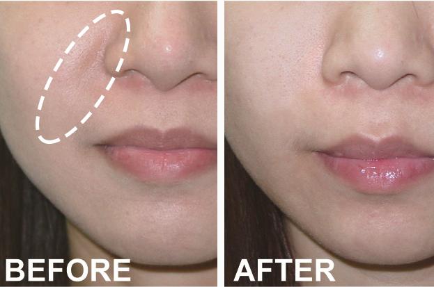 抬头纹眉间纹怎么去除,眉间纹抬头纹去除最好的方法