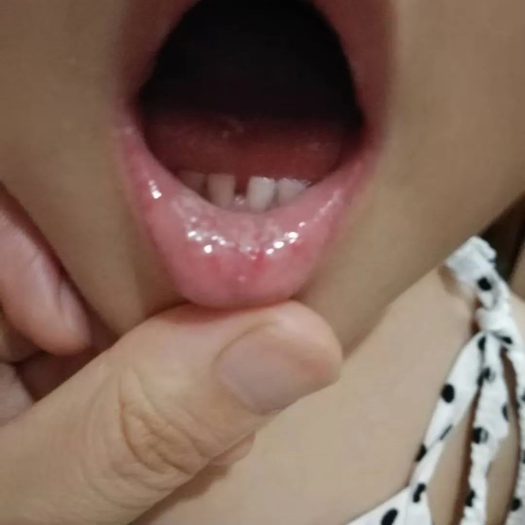 孩子嘴里反复起鹅口疮怎么办,宝宝嘴里长鹅口疮是什么引起的