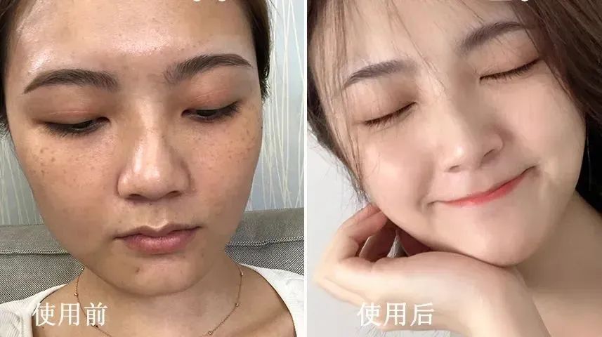 花了3万做激光，才彻底懂了：医生为什么劝你别去斑