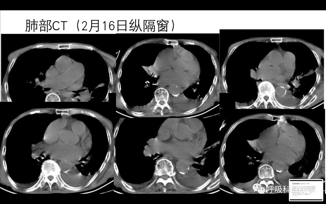 痰液培养阳性是否一定要用抗菌素？——为什么临床微生物学思维很重要（2）