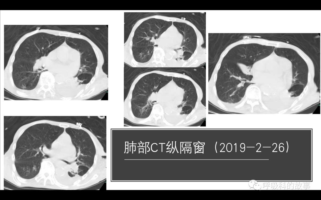 痰液培养阳性是否一定要用抗菌素？——为什么临床微生物学思维很重要（2）