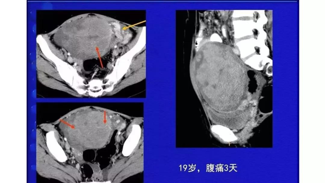 卵巢原发肿瘤的分析思路