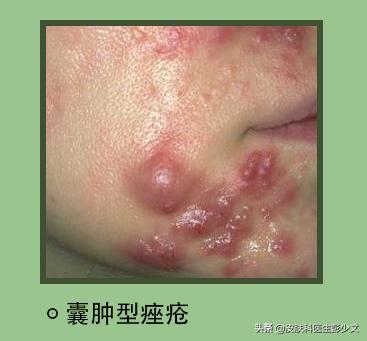 连续十年不停的长痘疮是怎么回事,身上长痘疮怎么治疗