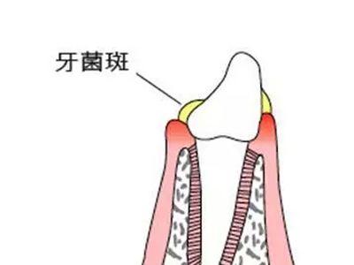 张嘴臭有异味怎么办,张嘴臭说话臭怎么治疗