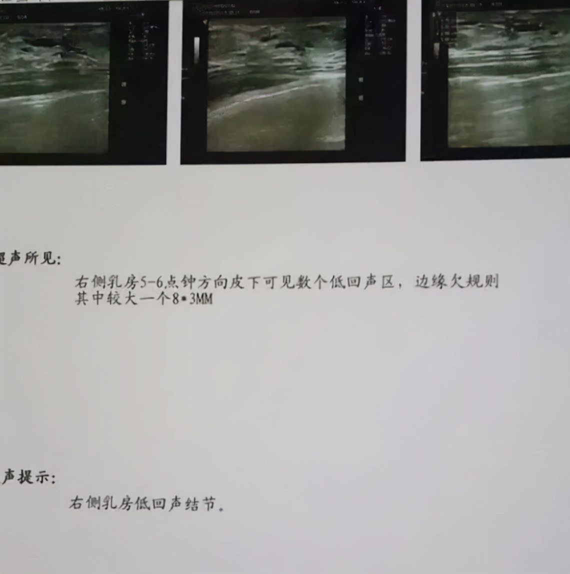 乳房结节切除，看似一劳永逸的手术，实则是将患者“画地为牢”
