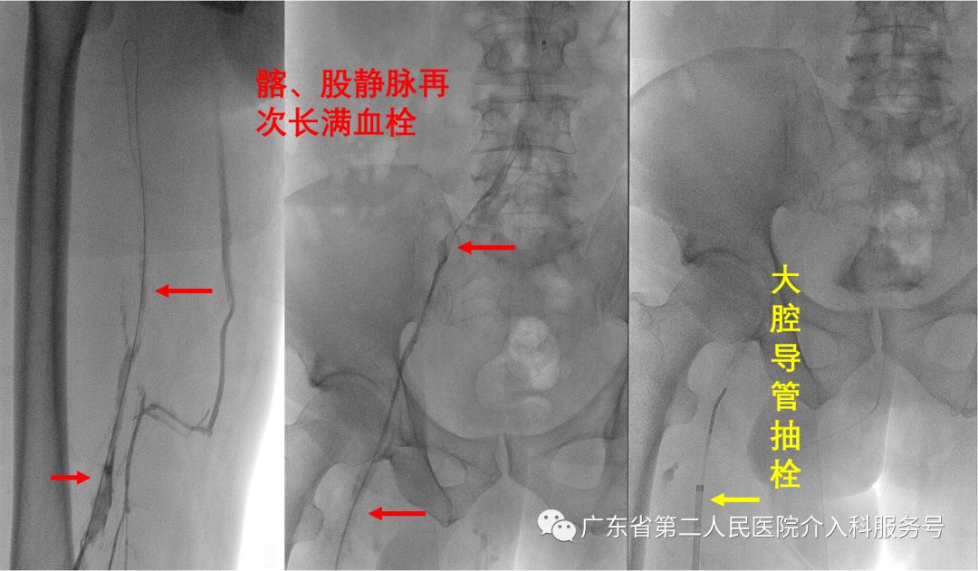 左腿血栓肿胀能完全恢复正常吗,左腿血栓肿痛怎么锻炼