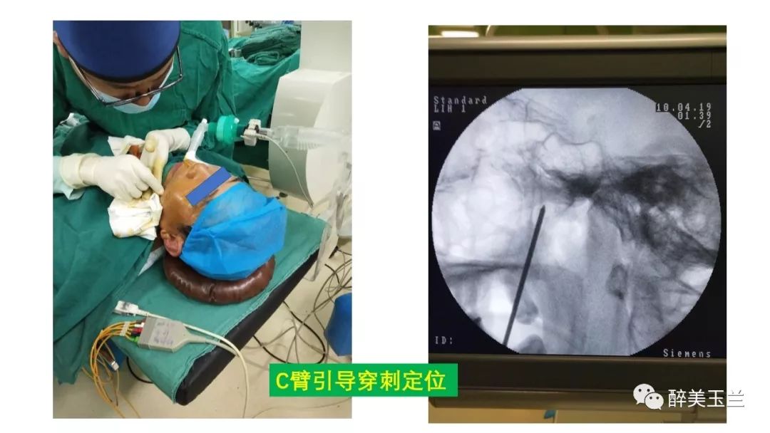 病例分享丨三叉神经节微球囊压迫术的麻醉管理