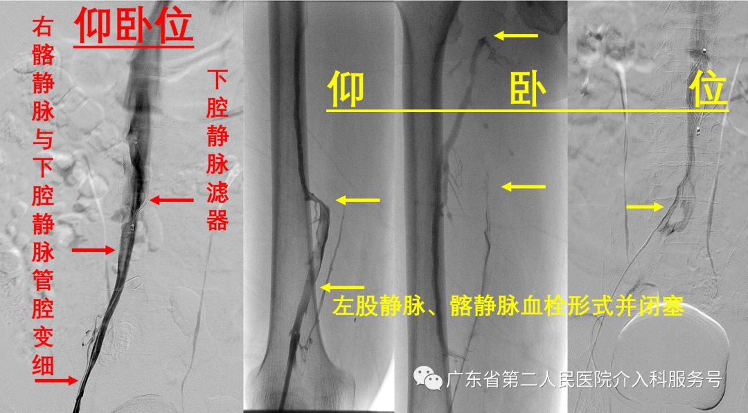 左腿血栓肿胀能完全恢复正常吗,左腿血栓肿痛怎么锻炼