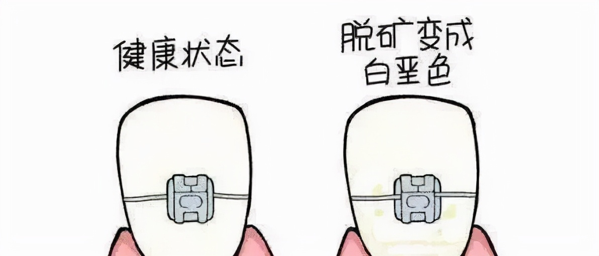 牙齿脱矿用含氟牙膏有用吗,一岁半宝宝牙齿脱矿怎么办