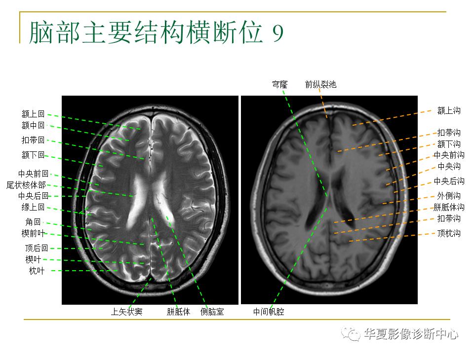 中国人脑立体定向mri应用解剖图谱,脑mri示意图