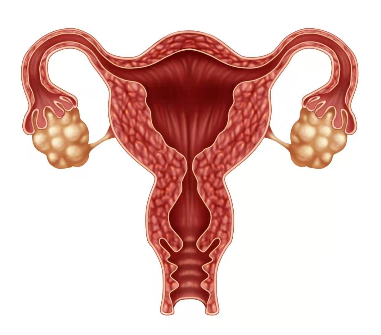 子宫腺肌症子宫切除能根治吗,子宫腺肌症不切除子宫的最新治疗