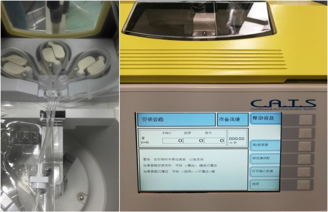 马康：术中自体血液回收