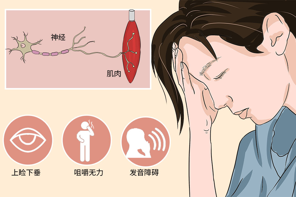 全身型重症肌无力预后,胆碱酯酶治疗重症肌无力的原理