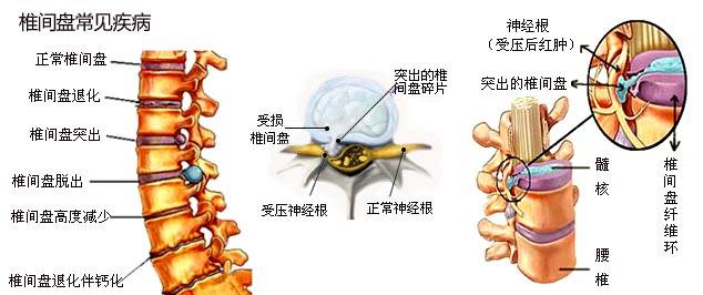 久坐伤肾久站伤筋久视伤血怎么办,久坐腰痛的症状和治疗方法