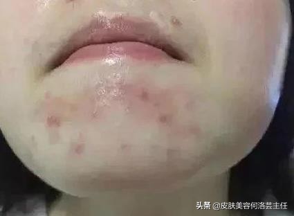 吃火锅长痘吃什么药好呢,长痘吃火锅吃什么好
