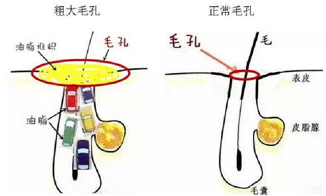 毛孔粗大不知道怎么救,毛孔粗大怎么改善不用护肤品