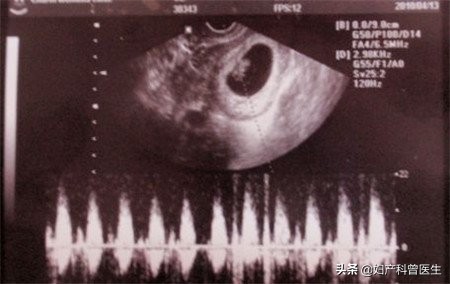 孕期多做b超对胎儿有影响吗,孕期做b超对胎儿有什么影响