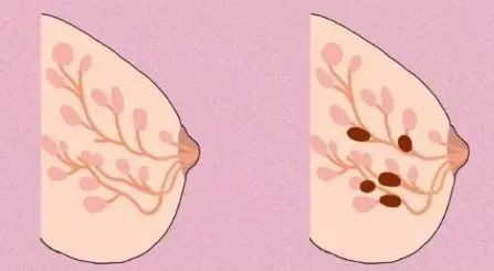 乳房有包块会得乳腺癌吗,发现乳房肿块几个月会癌变