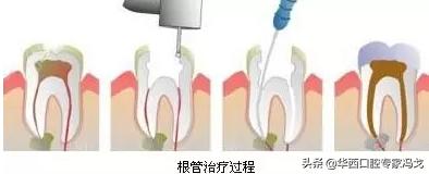牙齿龋坏补牙多少钱,门牙龋坏了建议补牙还是做牙冠