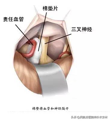血管压迫三叉神经痛会痛一辈子吗,原发与继发三叉神经痛如何治疗