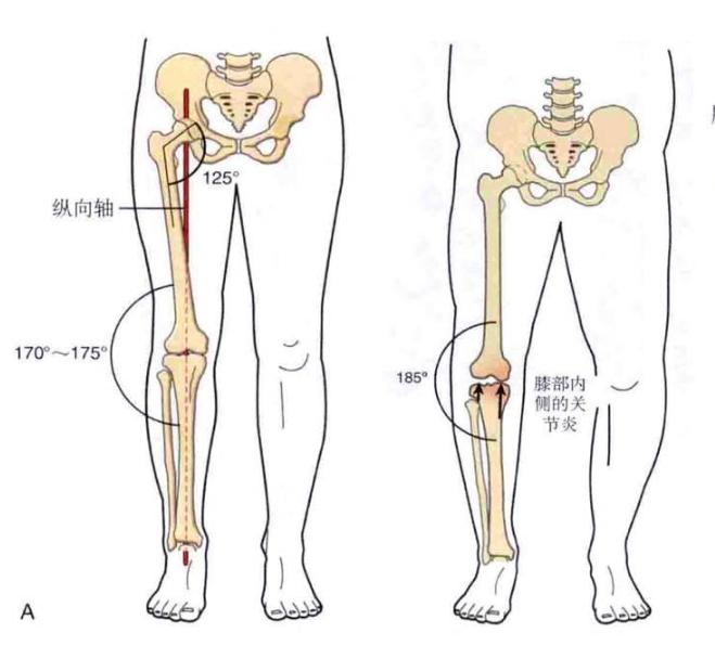 詹姆斯o型腿为什么不手术,詹姆斯罗圈腿为什么膝盖不会受伤