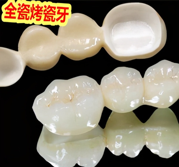 牙科全瓷冠与烤瓷冠有何区别,牙科中的临时冠和全瓷冠