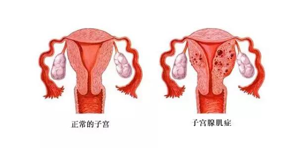 痛经摘除子宫能解决问题吗,真的有人痛经痛到要上医院