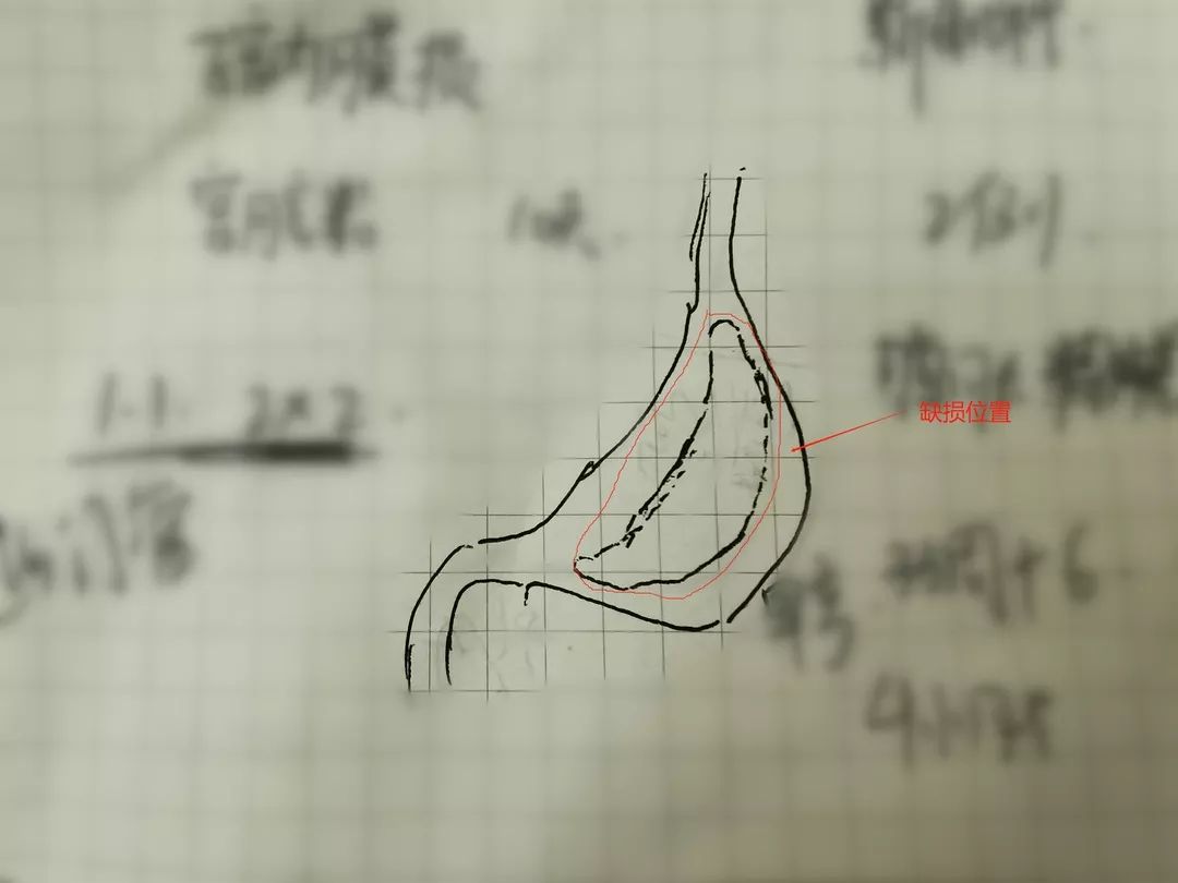 心疼！出生2天早产儿腹胀如包子生命垂危，医生打开腹...