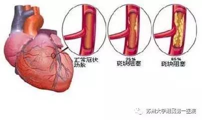 冠心病最怕的8个误区,冠心病健康讲座计划