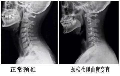 颈椎生理曲度变直会导致手臂疼吗,颈椎生理曲度变直会引起眩晕症吗