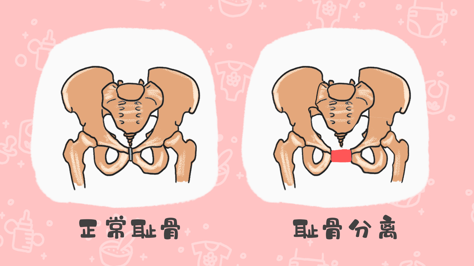 孕期有种“难熬”叫耻骨痛，这类孕妈更容易中招，要多加注意！