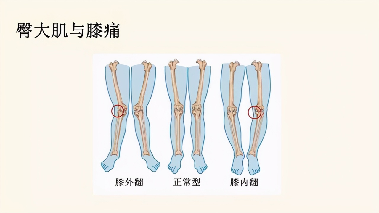 臀大肌无力会对步行有什么影响,臀大肌无力会引起腿疼吗