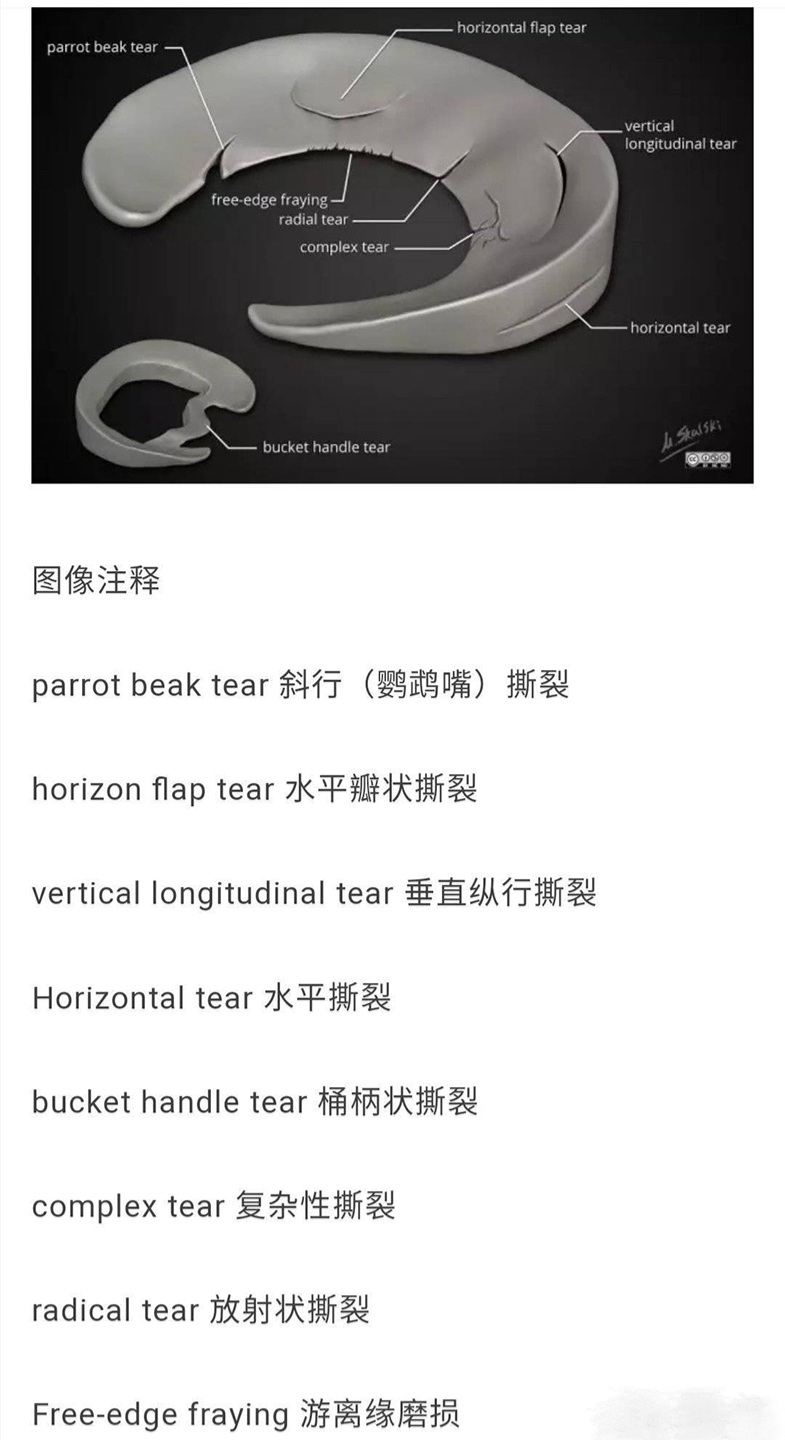 半月板损伤手术后多久能负重干活,半月板损伤后多久能负重