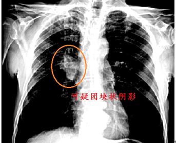 肿瘤标志物多少钱,肿瘤标记物是癌症吗