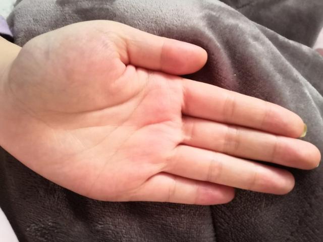 中药治疗腮腺炎、低热患者病案1例（1周）