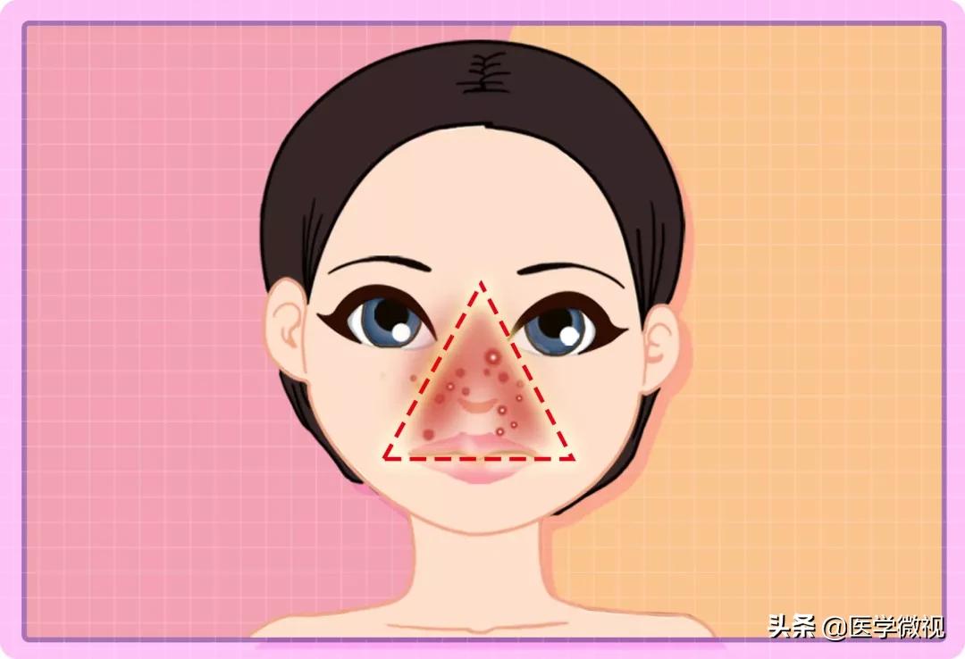 满脸痘痘怎么治不花钱,满脸痘痘中药调理效果如何