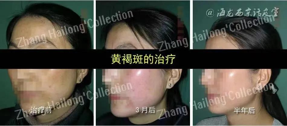 褐斑怎么治用什么药,脸黄长褐斑