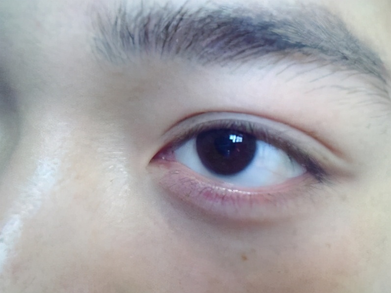 先天性肌营养不良症大脑有问题吗,进行性肌营养不良遗传方式是什么