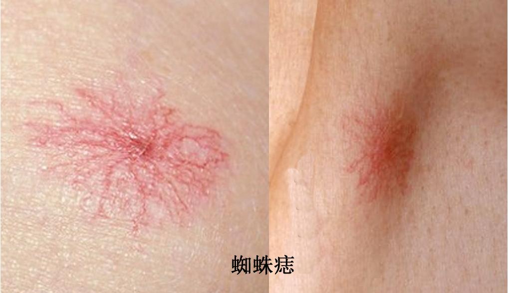 皮肤上有小黑点点是皮肤癌吗,癌症身上起小红点很痒图片