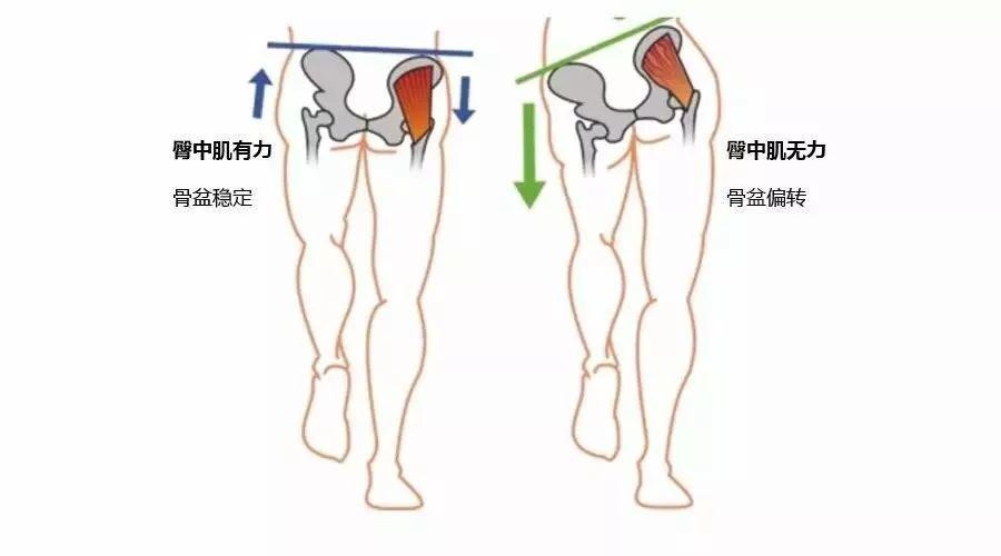 臀大肌无力会对步行有什么影响,臀大肌无力会引起腿疼吗