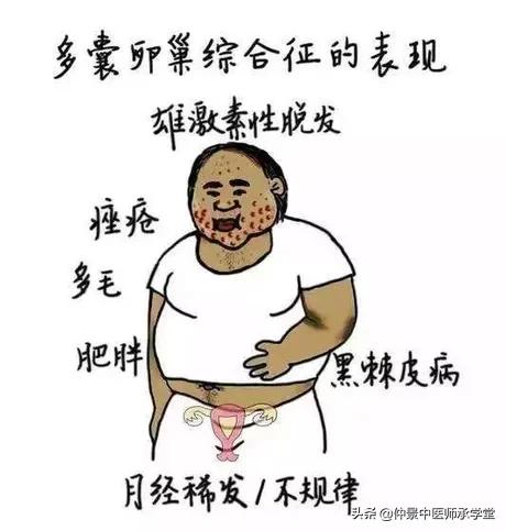 中医治多囊最好的方子,中医治疗多囊用西药吗